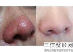 哪个医院鼻子整形好啊，整容鼻子哪个医院好