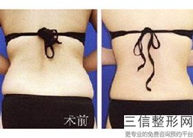 哪里丰胸医院好，丰胸哪个医院