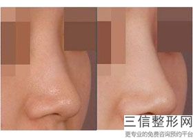 南昌假体隆鼻要多少钱，南昌做鼻子价格