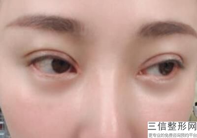 南宁双眼皮修复的价格，南宁哪个医院割双眼皮比较好