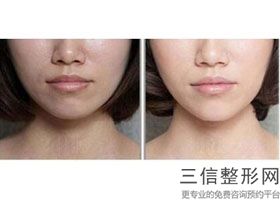 皮秒祛斑一般的价格，皮秒祛斑的价格一般是多少啊