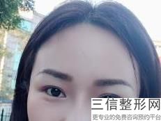 切开双眼皮和全切双眼皮,切开双眼皮和割双眼皮的区别