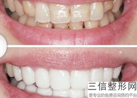 轻度牙齿拥挤怎么矫正，牙齿拥挤怎么矫正