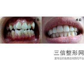 请问医生做种植牙痛苦吗，做种植牙危险吗
