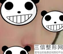 去鼻子假体多少钱，鼻子假体需要多少钱