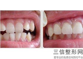全瓷牙的利与弊,全瓷牙套的优缺点