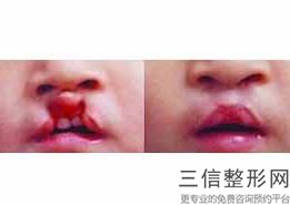 如何让嘴唇变薄变小，怎样把嘴唇变小变薄
