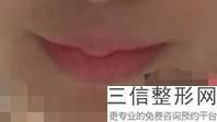 如何让嘴唇变薄变小，怎样把嘴唇变小变薄