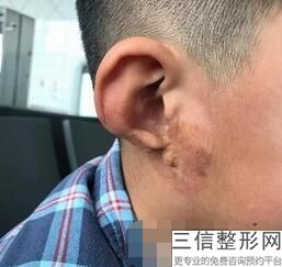 上海儿童耳朵整形医院哪家好,上海耳科整形医院排名