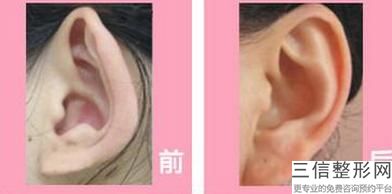 上海儿童耳朵整形医院哪家好,上海耳科整形医院排名