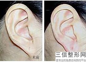 上海儿童耳朵整形医院哪家好,上海耳科整形医院排名