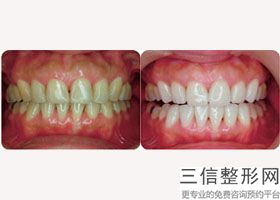 什么叫牙齿缺失，牙齿缺损怎么治疗