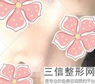 是塌鼻子怎么办，鼻子是塌鼻子怎么办