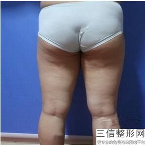 手臂吸脂好还是溶脂好，手臂吸脂用哪种好