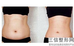 手臂吸脂以后小臂肿的不行，手臂吸脂有效果吗