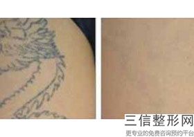 手术拉皮效果好还是线雕效果好，拉皮手术与线雕的区别