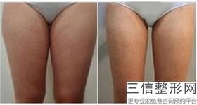 瘦腹部比较有效的方法，腹部如何瘦身