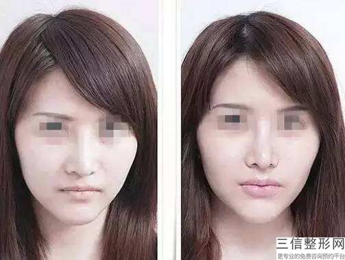 双下巴怎么去掉-，双下巴有肉怎么减掉