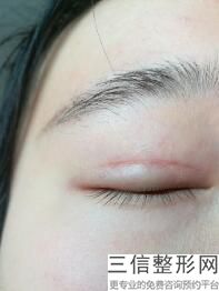 双眼皮修复百科,哪种双眼皮需要修复