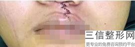 填泪沟用哪种玻尿酸,鼻唇沟填充用什么玻尿酸良好