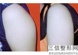 脱腿毛大概要多少钱，大腿脱毛多少钱