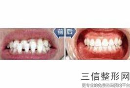 网上买的牙齿矫正器真的有用吗，网上买的牙齿矫正器真的管用吗