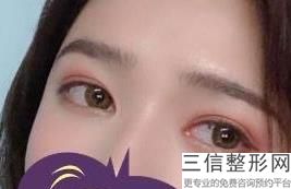 维生素e涂抹眼睛能去鱼尾纹吗，维生素e抹眼角纹能消除鱼尾纹吗