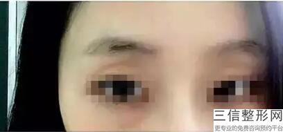 我做了超声波去眼袋，什么是超声波去眼袋