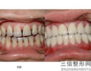 无法种植牙齿,缺失牙齿怎么弄，多颗牙缺失怎么种植