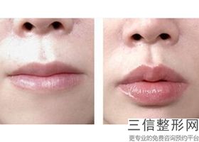 武汉漂唇哪家医院好，漂唇哪里比较正规