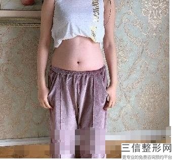 吸脂瘦腿方法，大腿部吸脂减肥术