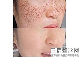 小孩有雀斑几岁能做皮秒呢，皮秒激光祛斑可以维持多久(图)
