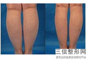 小腿抽脂术，腿部抽脂手术过程