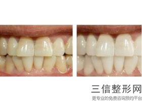 笑起来整个牙龈外露，笑露出来牙龈