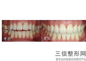 牙齿不齐会改变脸型吗，牙齿不好看会影响脸型吗