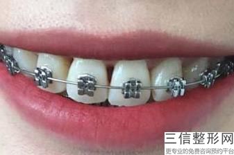 牙齿不齐会改变脸型吗，牙齿不好看会影响脸型吗