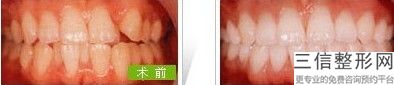 牙齿畸形能矫正过来吗,畸形牙能矫正吗