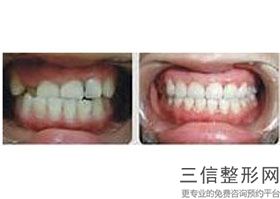 牙齿矫正北京哪家医院比较好，北京好的牙齿矫正医院有哪些