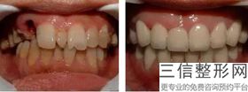 牙齿矫正器啥样，整牙矫正器种类的价位