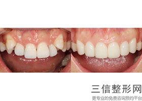 牙列不齐矫正后会改变脸型吗,牙列不齐怎么矫正