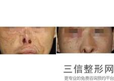 医院缩鼻翼多少钱，北京鼻翼鼻头缩小手术多少钱与过程
