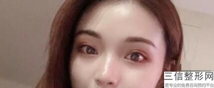 宜宾割双眼皮好的医院，宜宾割眼袋