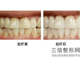 隐形矫正整牙,隐式矫正牙齿