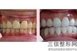 隐形牙齿矫正是什么样的，什么是数字化隐形正畸