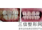 隐形牙套大概价格，隐形矫正牙套价格多少钱