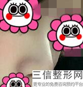 怎么隆鼻子的，怎么样选择隆鼻方法