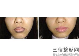 怎么样可以让嘴唇变薄变小，如何让嘴唇变小变薄天然方法