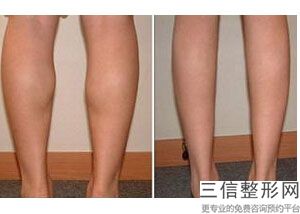 怎样才能快速瘦腿，怎样才能减掉大腿上的赘肉(怎样才能快速瘦大腿)？