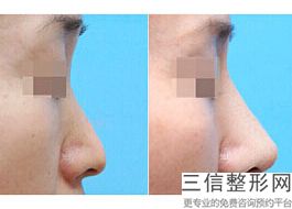整鼻子咋整，鼻子不好看只能整容吗