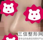 整鼻子咋整，鼻子不好看只能整容吗